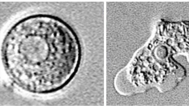 Texas woman dies from brain-eating amoeba after using tap water for sinus rinse