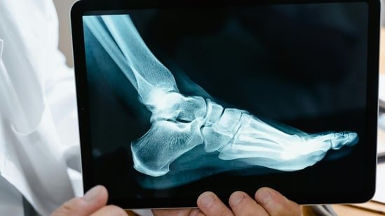 Physical exercise, nutrition and lifestyle choices affect bone health.(Pexel)