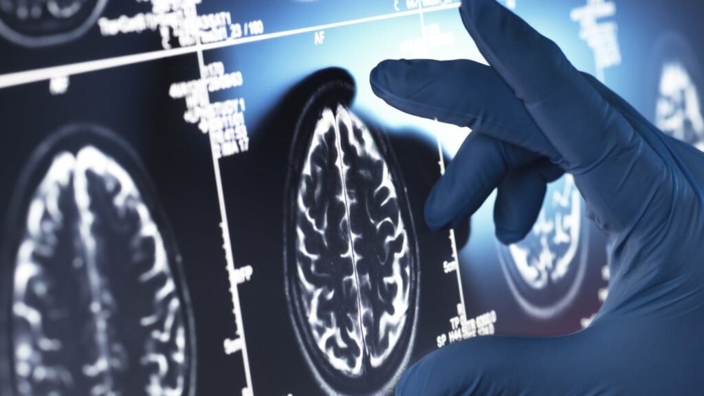 Alzheimer’s gene variant in Chinese linked to rapid decline: Hong Kong study