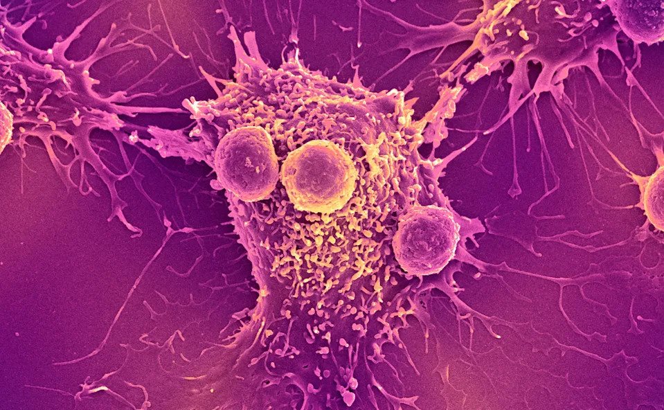 Colored scanning electron micrograph of white blood cells attached to a cancer cell.