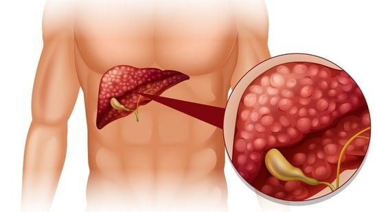 Liver cancer (primarily hepatocellular carcinoma) often develops over years, typically when the liver is under chronic stress. (Freepik)
